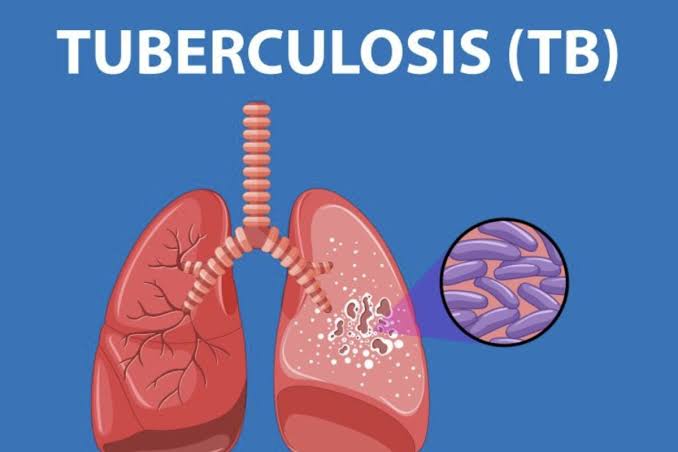 FCT Records 16,000 Tuberculosis Cases; Treatment Success Hits 94%